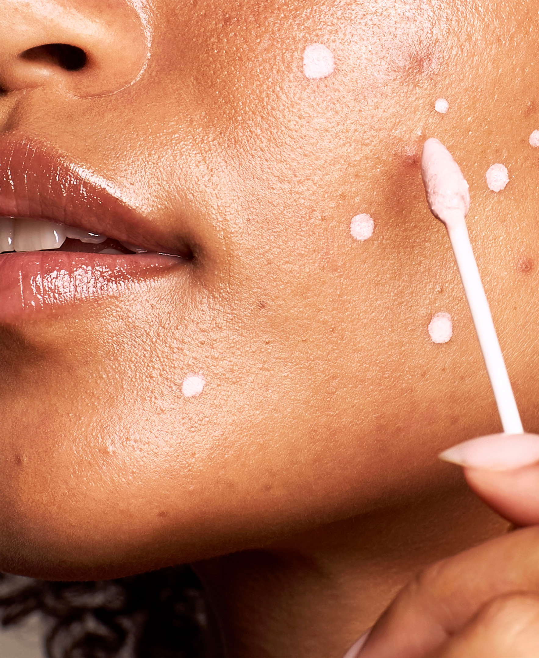 EradiKate Acne Treatment EradiKate Acne Treatment